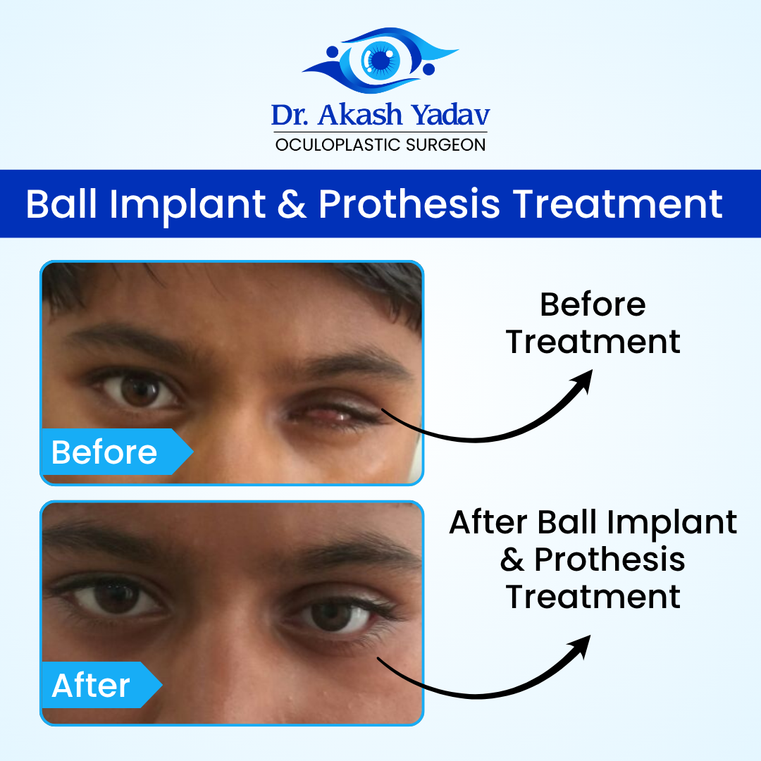 Akash Yadav - Before After Images (1)