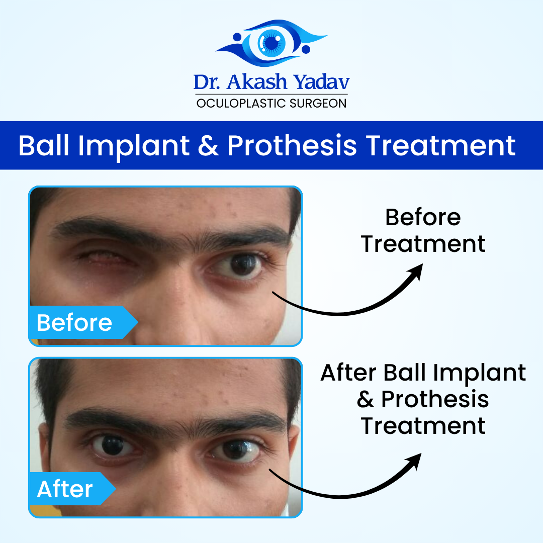 Akash Yadav - Before After Images (2)
