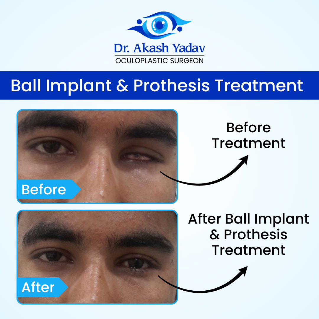 Akash Yadav - Before After Images