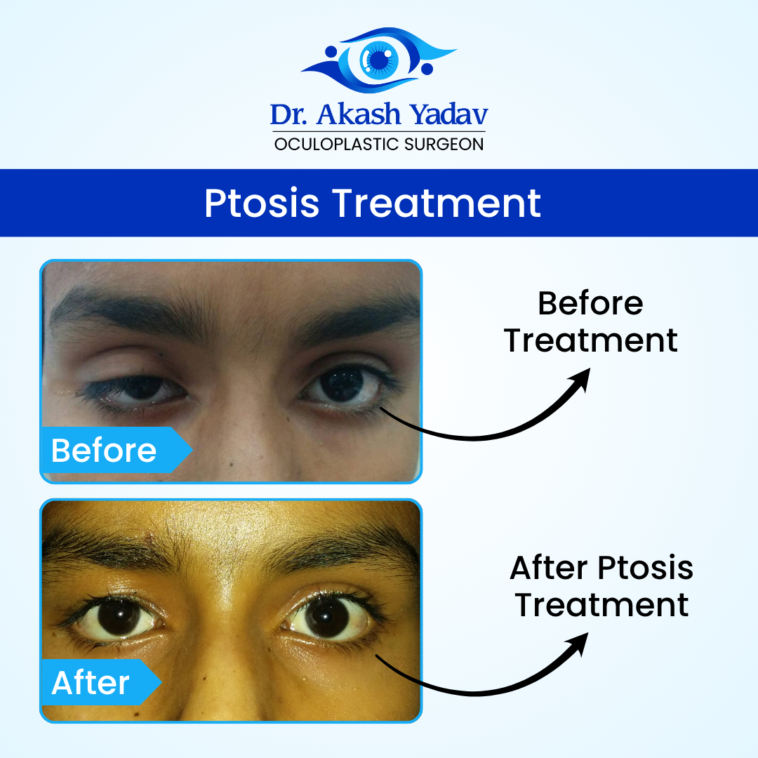 Akash Yadav - Before After Images (10)