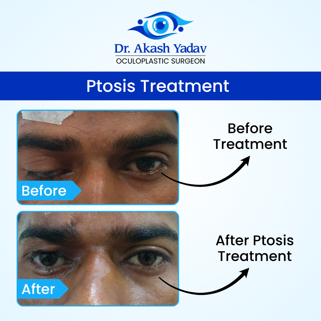 Akash Yadav - Before After Images (11)