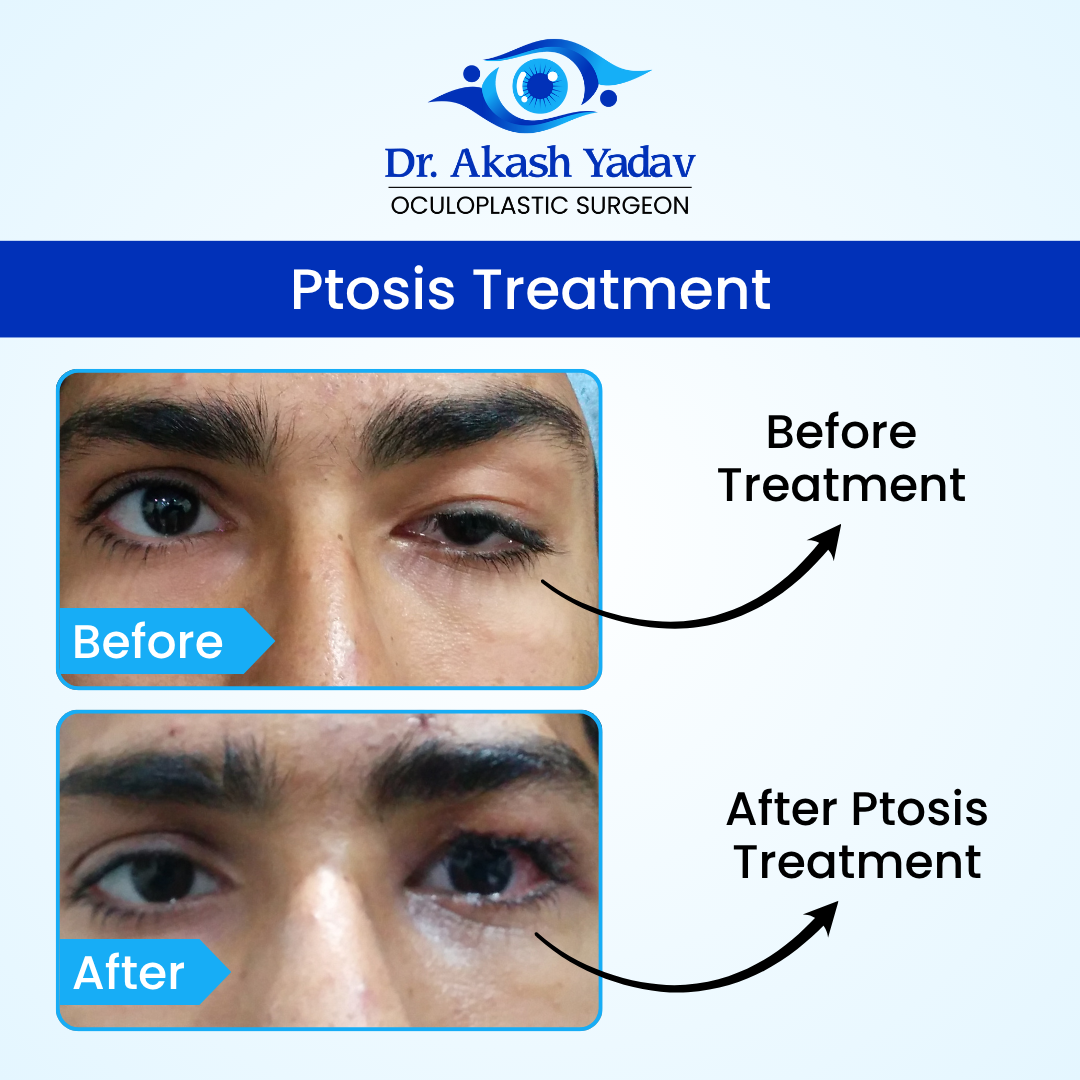 Akash Yadav - Before After Images (12)