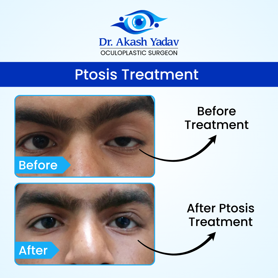 Akash Yadav - Before After Images (13)