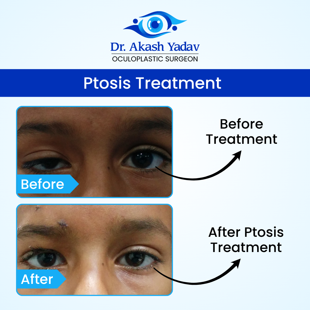 Akash Yadav - Before After Images (14)