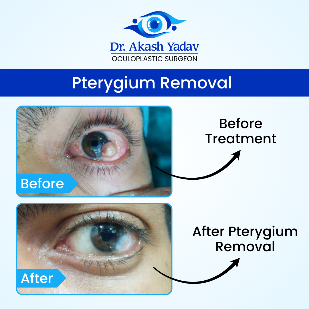 Dr. Akash Yadav performed surgeries Image - Pterygium Removal