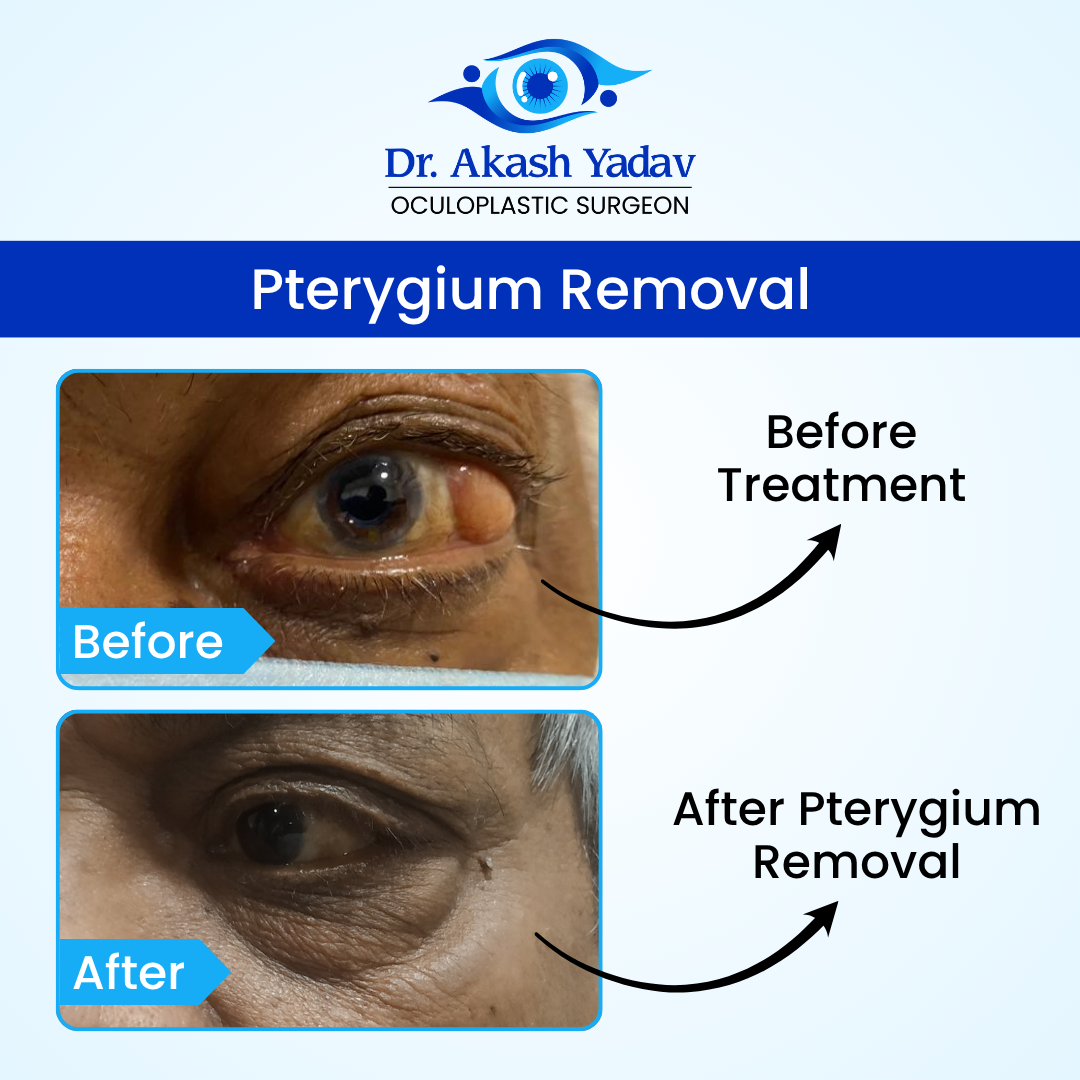 Dr. Akash Yadav performed surgeries Image - Pterygium Removal