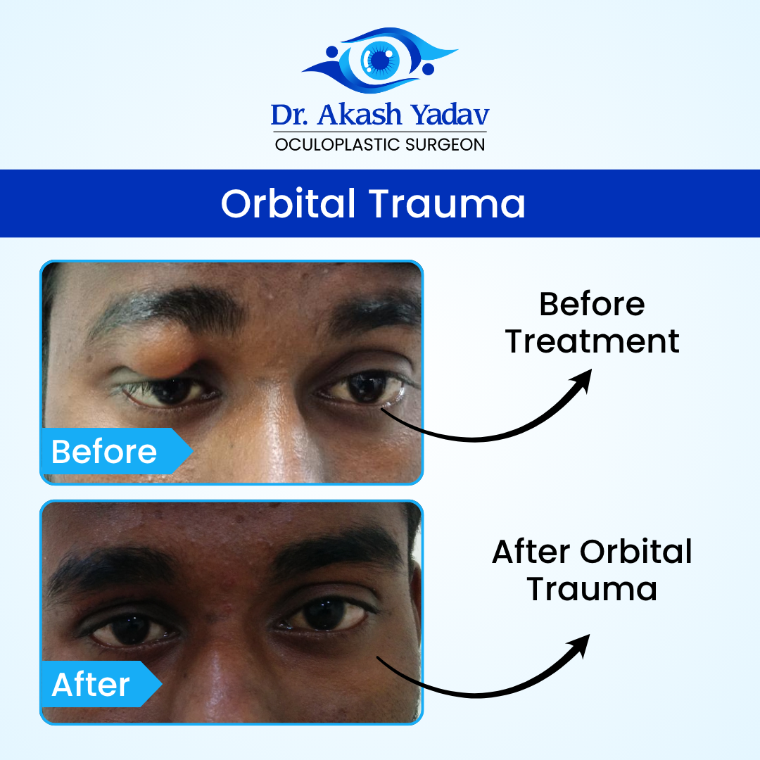 Dr. Akash Yadav performed surgeries Image - Orbital Trauma