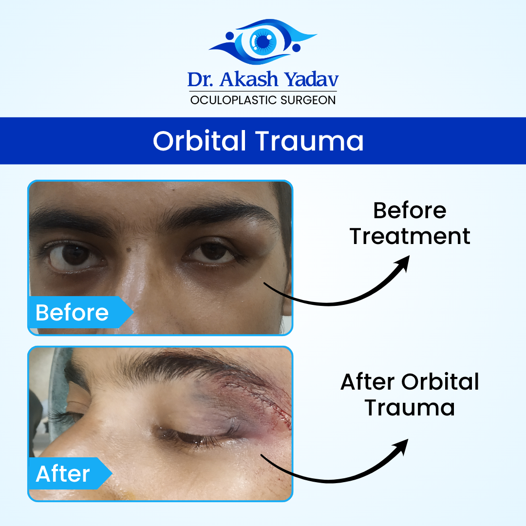 Dr. Akash Yadav performed surgeries Image - Orbital Trauma