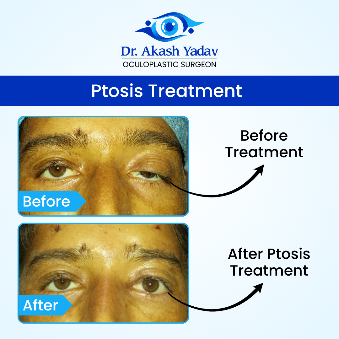 Akash Yadav - Before After Images (9)