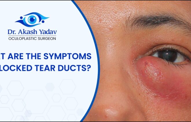 symptoms of blocked tear ducts