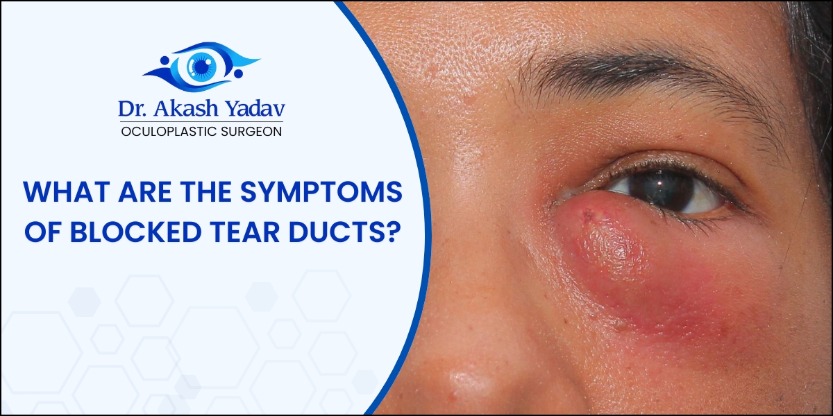symptoms of blocked tear ducts