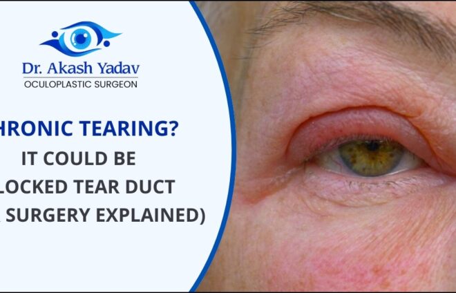 Blocked Tear Duct