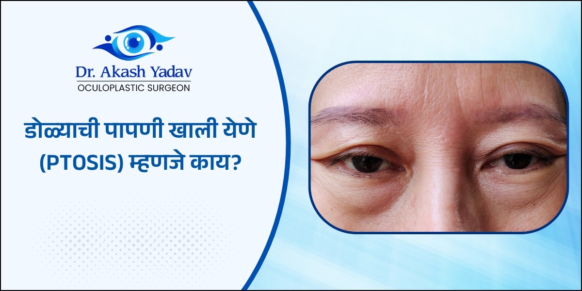 Ptosis म्हणजे काय?