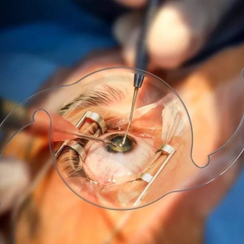 Cataract Services