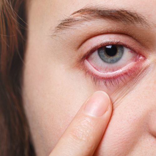 Dry Eye Treatment Dry Eye Treatment