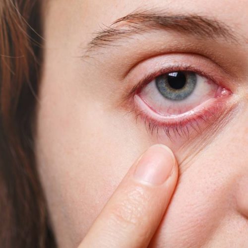 Dry Eye Treatment