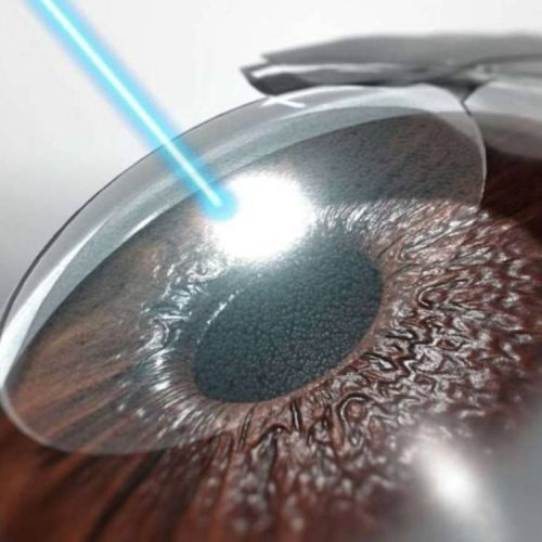 LASIK & Refractive Surgery